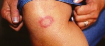 A hanseníase é uma doença infectocontagiosa causada por uma bactéria