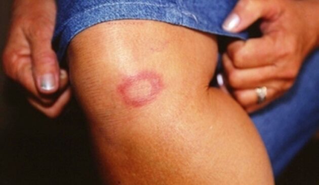A hanseníase é uma doença infectocontagiosa causada por uma bactéria