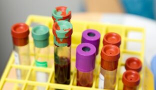 Novo exame de sangue pode ajudar no diagnóstico de Alzheimer