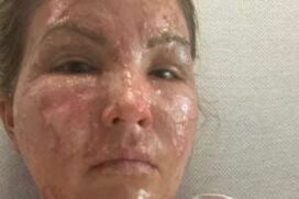 A americana Kate Wise está se recuperando em uma UTI (Unidade de Terapia Intensiva).