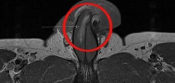 O relato do caso, publicado no British Medical Journal em 10 de junho, detalha como um homem de 40 anos machucou gravemente o órgão durante uma relação sexual. 