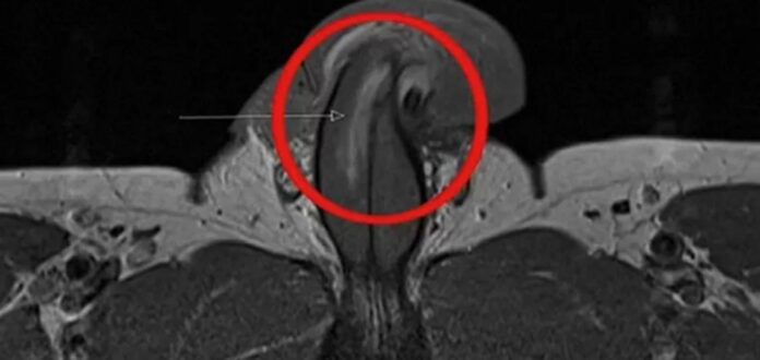 O relato do caso, publicado no British Medical Journal em 10 de junho, detalha como um homem de 40 anos machucou gravemente o órgão durante uma relação sexual.
