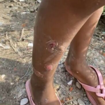 Sarna humana chega a São Vicente e atinge comunidades