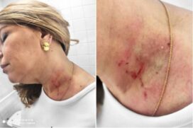 Vereadora Cris Monteiro (Novo) mostra marcas de uma suposta agressão da colega Janaína Lima