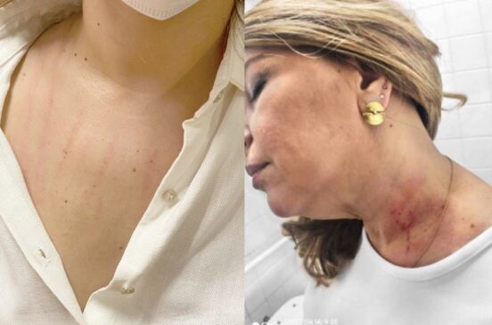 Jana&iacute;na Lima e Cris Monteira mostram supostas agress&otilde;es